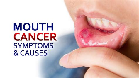 Mouth Cancer Symptoms And Causes Dr Anwar Amir Ansari Cancer Hope Youtube