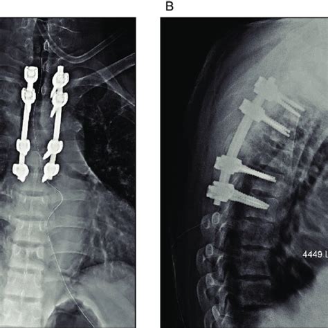 Anteroposterior A And Lateral B Post Operative Radiographs After