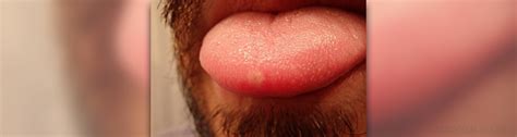 Cold Sores On Tongue Ear Nose Throat And Dental Problems Articles