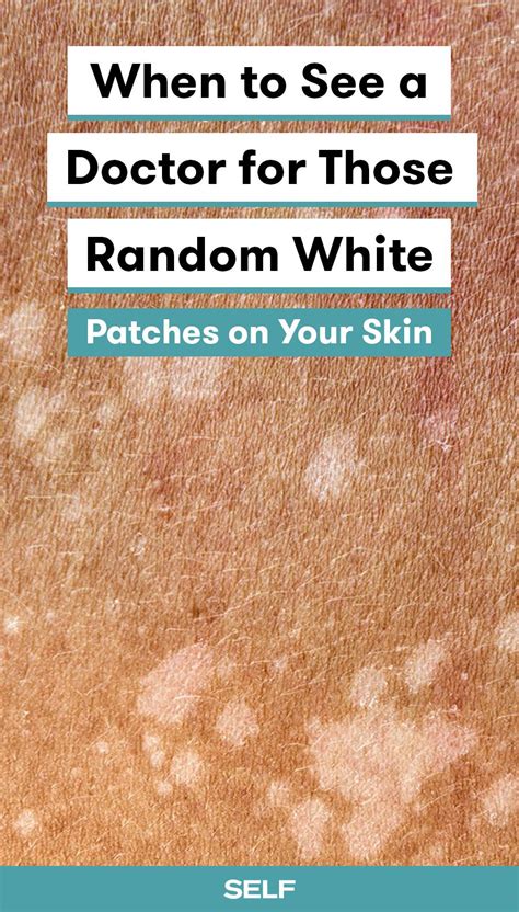 White Patch On Skin A Cause For Concern White Skin Patches White