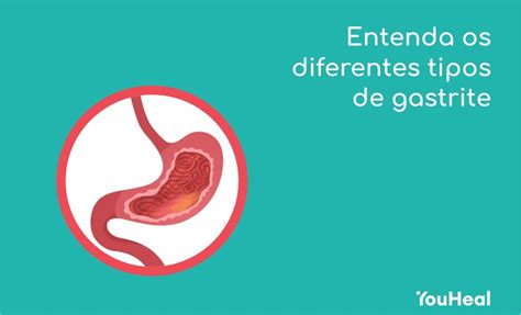 Gastrite Antral Enantematosa Discreta