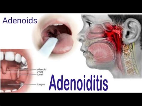 Adenoiditis Adenoids Symptoms Causes Complications Diagnosis And