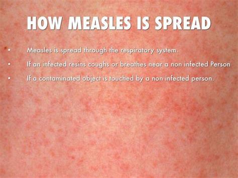 Measles Viral Infections
