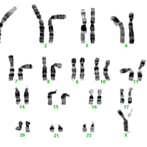 A Karyotype Of The 3 Rd Patient With X Chromosome Showing Fragile Site