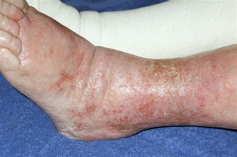 Cellulitis Of The Leg Stock Image C0017302 Science Photo Library