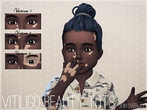 Vitiligo Beauty Skin Overlay Toddlers N4 The Sims 4