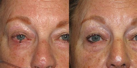 Eyelid Reconstruction Gallery Skin Cancer And Reconstructive Surgery