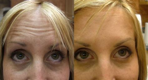 Wrinkle Treatment Before And After Botox Dermal Fillers