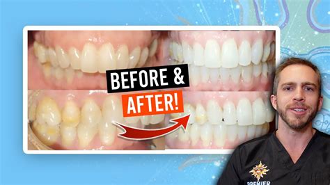 Adult Braces Overbite Treatment Before And After Youtube