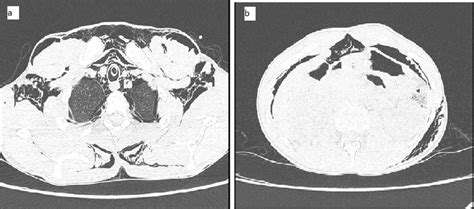 A High Resolution Computed Tomography Hrct Thorax Showed Gross