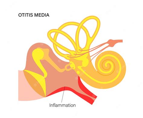 Premium Vector Otitis Media Disease