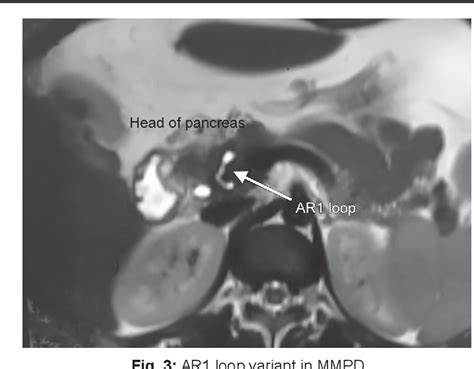Figure 1 From Meandering Pancreatic Duct As A Cause Of Idiopathic