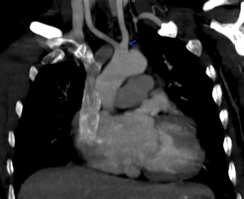 Postcontrast Computed Tomography Angiography Coronal Image Shows A