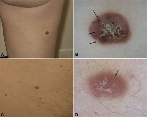 Not All Lesions With A Verrucous Surface Are Seborrheic Keratoses Journal Of The American