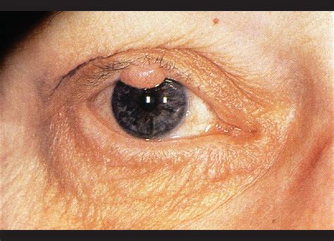 Pathology Of Eyelid Tumors Peer J Indian J Ophthalmol