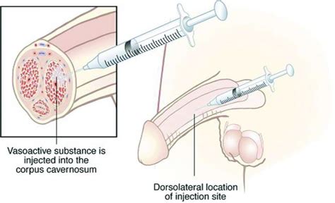 Penile Injection Therapy