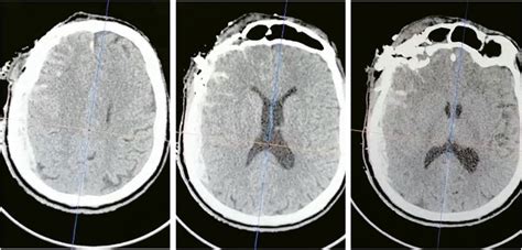 Preoperative Axial Ct Showing Right Sided Subdural Hematoma Effaced