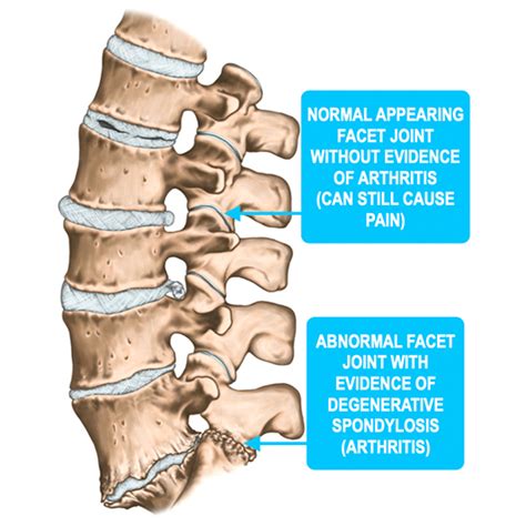 Cervical Facet Syndrome The Orthopedic Pain Institute Beverly Hills