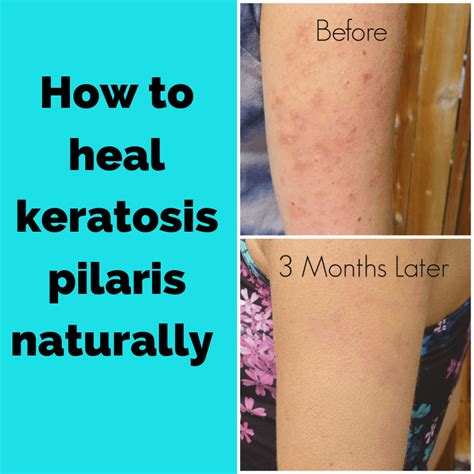 Keratosis Pilaris Organic Treatment See Now Keratosis Pilaris