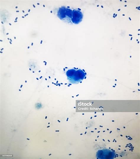 Cerebrospinal Fluid With White Blood Cells Engulfing Pneumococci Stock