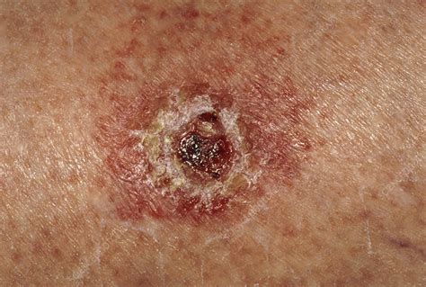 Basal Cell Carcinoma On Leg Of Elderly Woman Stock Image M1310287