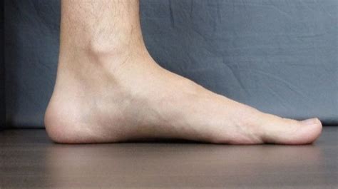 Flat Foot Penyebab Dan Cara Mengobatinya