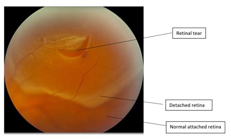 Retinal Detachment Ophthalmology Geeky Medics