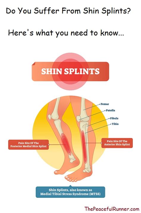 Do You Have Shin Splints Heres What You Need To Know