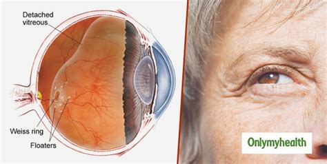 Floaters And Flashes In The Eyes Causes And Treatment Onlymyhealth