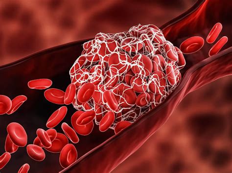 Covid 19 Linked To Risk Of Dangerous Blood Clots In Stroke Patients