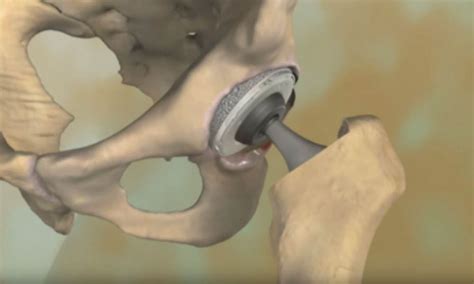 Dislocation After Hip Replacement Orthoinfo Aaos