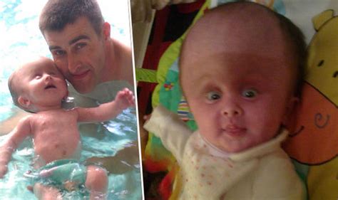 Baby With Rare Condition Born With Adult Sized Head