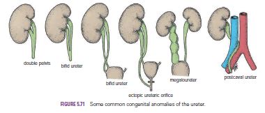 Human Medecine: Ureter- Ureteric Stones-Renal Colic-Traumatic Ureteral Injuries