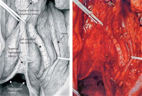 Sexual Function In Men And Women With Neurological Disorders The Lancet