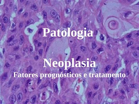PPT Patologia Neoplasia Fatores prognósticos e tratamento DOKUMEN TIPS
