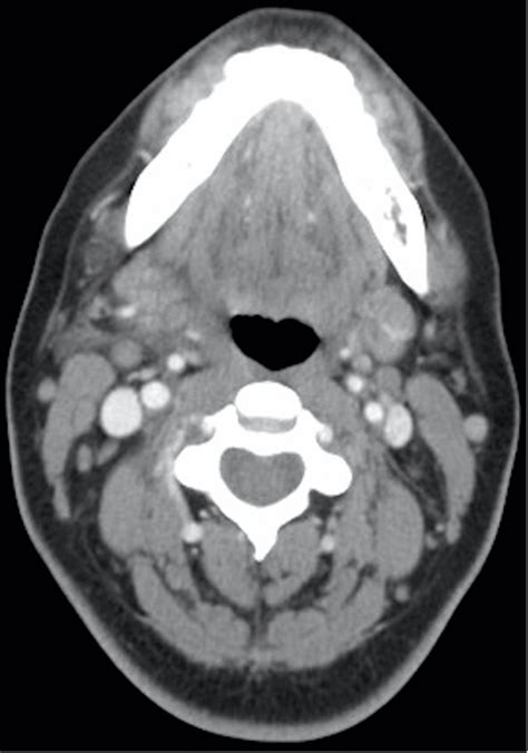 Cureus Acute Submandibular Sialadenitis