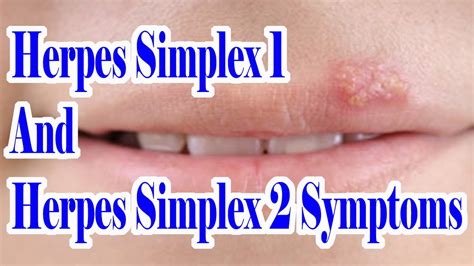 Herpes Simplex 1 And 2 Symptoms Which Herpes You Are Suffering From