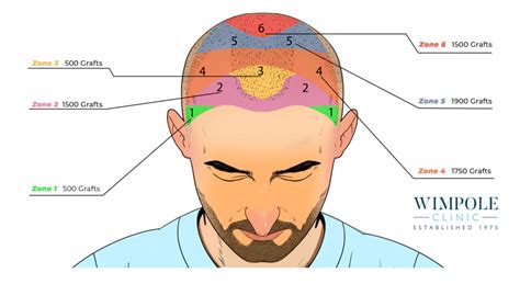 Male Pattern Baldness Causes Stages And Treatment Options