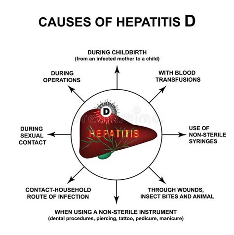 Causas De La Hepatitis D D?a De La Hepatitis Del Mundo Infograf?a Ejemplo Del Vector En Fondo ...