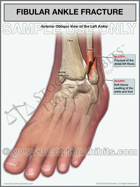 Ankle Fracture Fibular Fracture Of The Left Ankle Stock Trial Exhibits