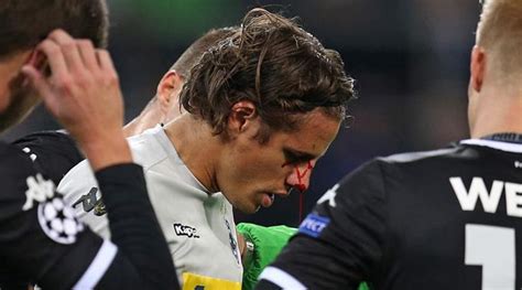 Gladbachs keeper yann sommer erlebte zuletzt turbulente wochen. fussball.ch - Nasenbeinbruch: Sommer muss operiert werden ...