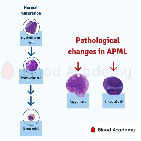Acute Promyelocytic Leukaemia Blood Academy