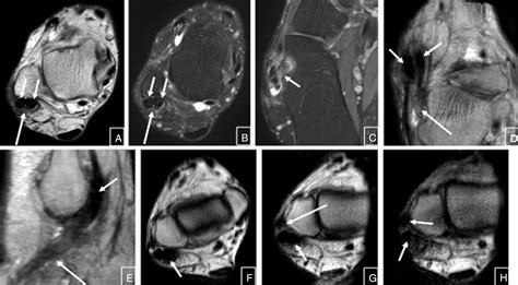 Kinematic Magnetic Resonance Imaging Of Peroneal Tendon Subluxation