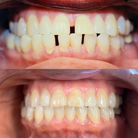 Invisalign Before And After Firouz Orthodontics West Los Angeles