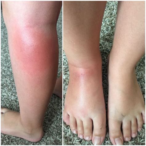 Do You Have Skeeter Syndrome A More Severe Reaction To Mosquito Bites