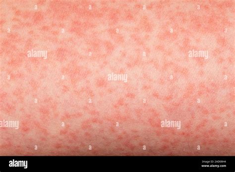 Scarlet Fever Close Up Of A Rash On The Skin Of A 15 Year Old Female