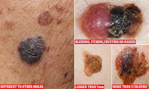Screening Nurse Reveals How To Spot Cancerous Moles At Home Daily