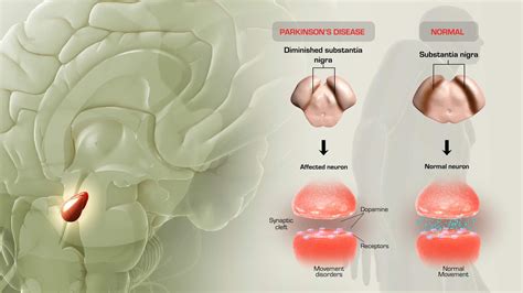 Parkinsons Disease What Goes Wrong Scientific Animations