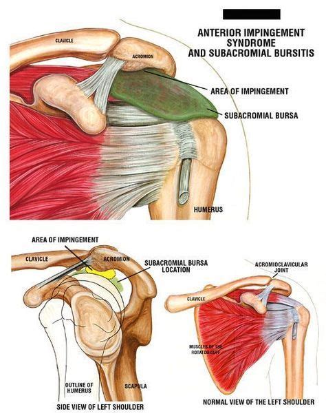 How is impingement syndrome diagnosed? shoulder impingement | ... , depicting Shoulder ...