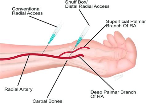 Transradial Approach Versus Anatomical Snuff Box Distal Radial Access